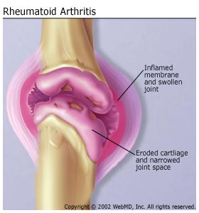 Rheumatoid Arthritis